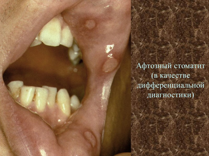 Афтозный стоматит (в качестве дифференциальной диагностики)